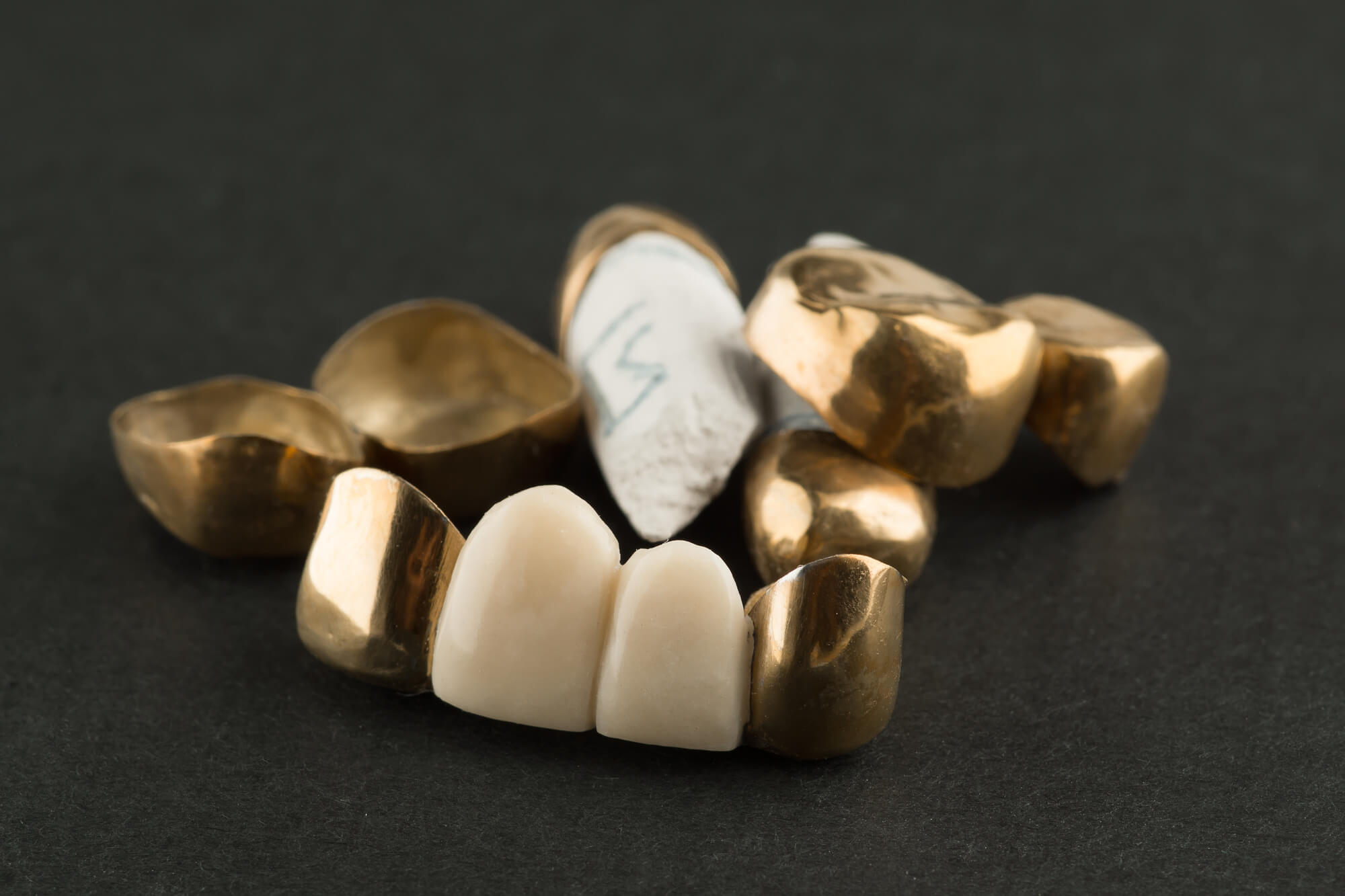 gold and ceramic crystal river dental crowns