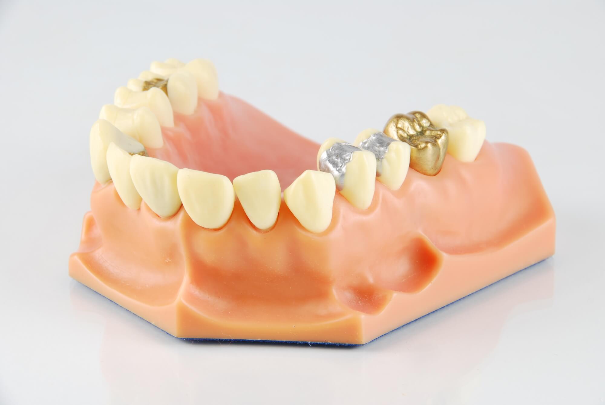 gold crystal river dental crowns and other treatments
